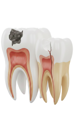 Chipped or Broken Teeth