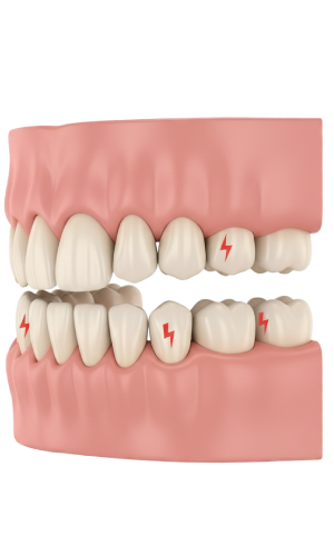 Crowded Teeth