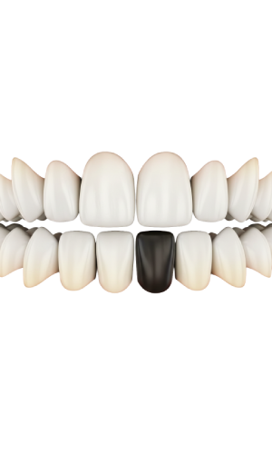 Dark Tooth Discolouration