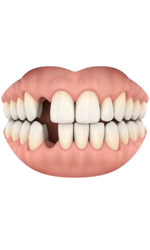 Gaps Between Teeth