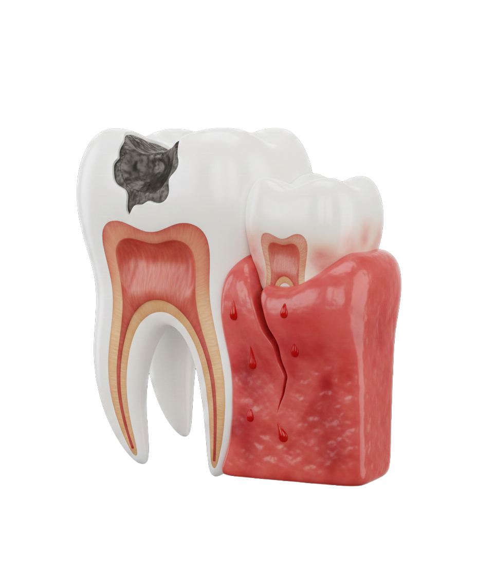 Gum or Soft Tissue Injury