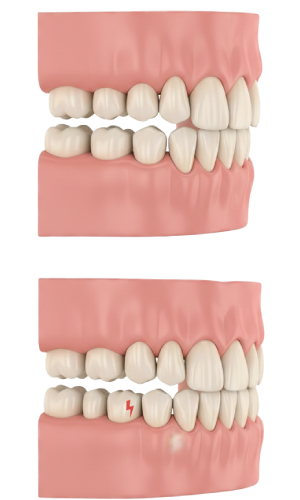 Overbites and Underbites