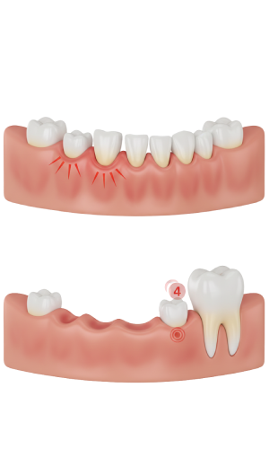 Teething and Early Tooth Loss